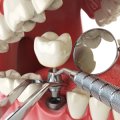 Dental Implants Dentist Nearby You | Full Mouth Dental Implants Treatment